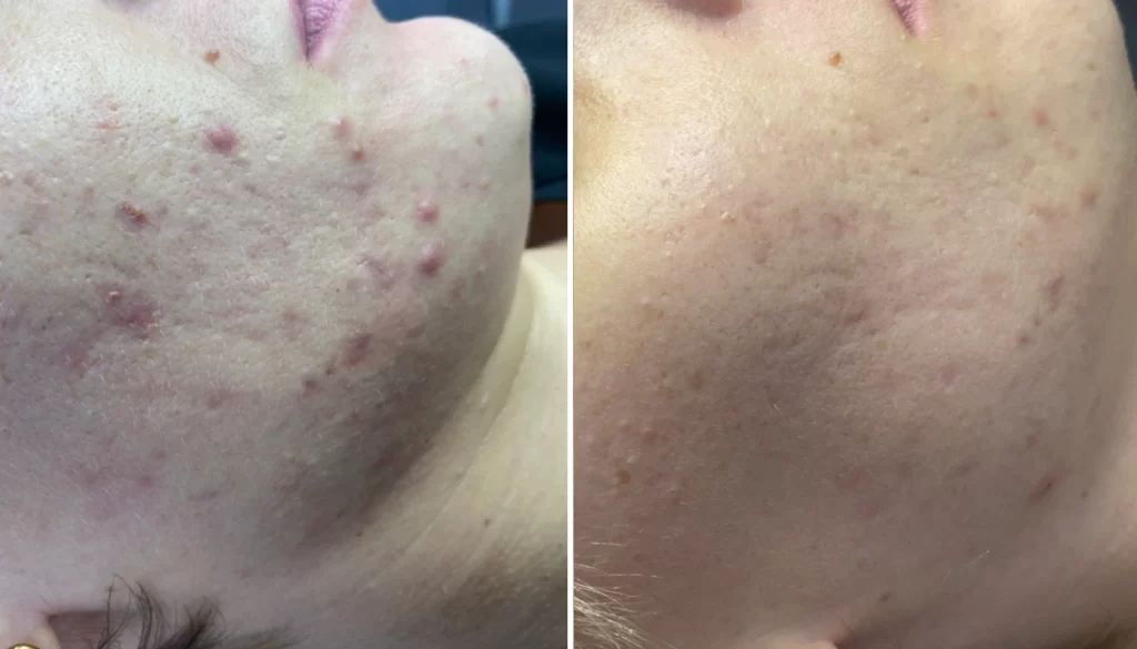 K Beauty SPOT - B-A - Nega obraza ACNE HACQUER