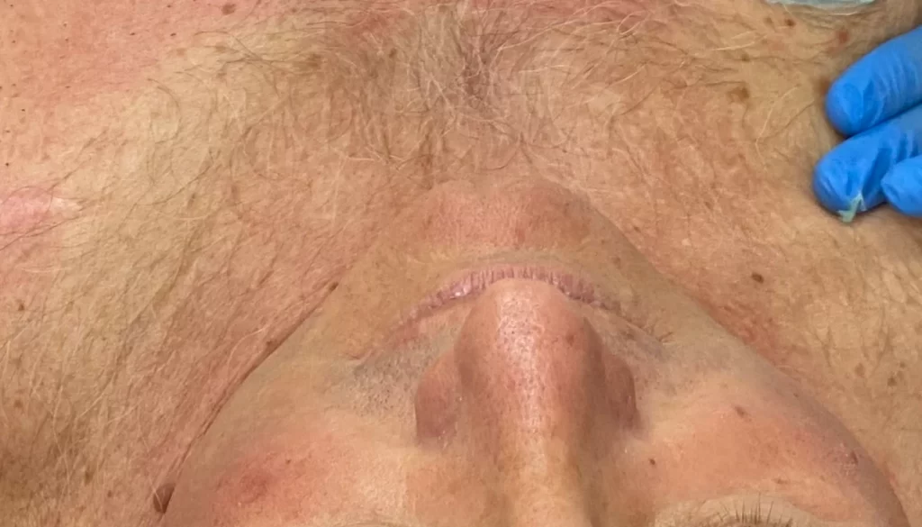 K Beauty SPOT - B-A - depilacija 2