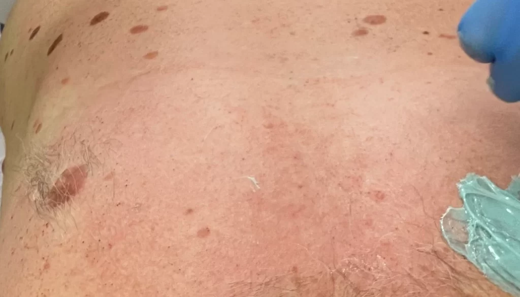 K Beauty SPOT - B-A - depilacija 3