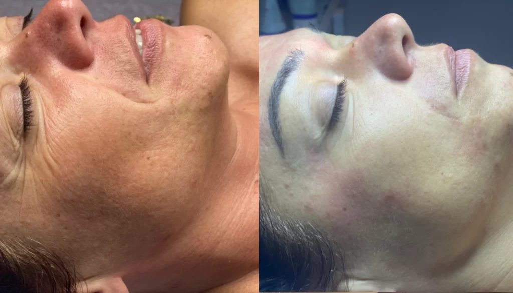 K Beauty SPOT - B-A - microneedling