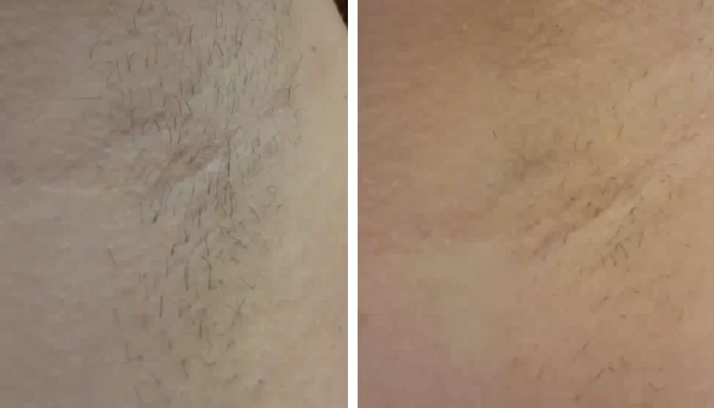 K Beauty Spot Lasersko Odstranjevanje Dlak 1