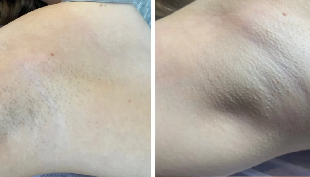 K Beauty Spot Lasersko Odstranjevanje Dlak